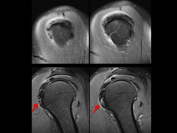 Figure 3 for case calcium hydroxyapatite crystal deposition disease ( RID3594 )